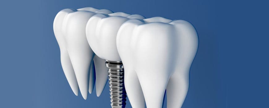 Tooth implant