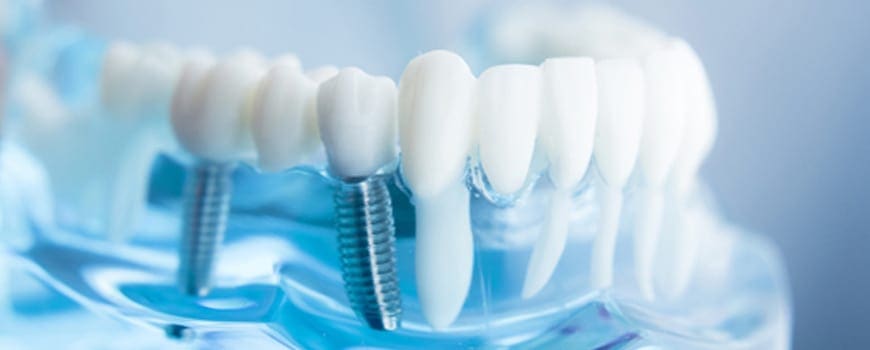 Dental Implants