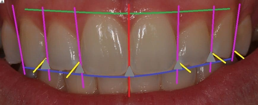 Dental Smile Landmarks of Teeth