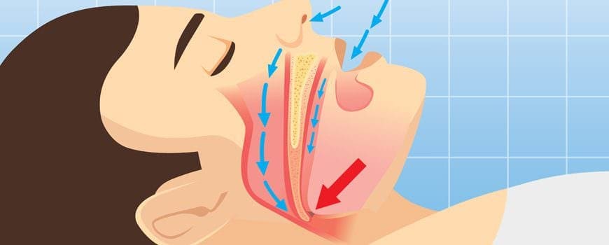 Sleep Apnoea Diagram