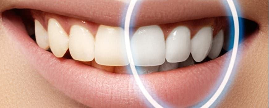 Teeth Whitening