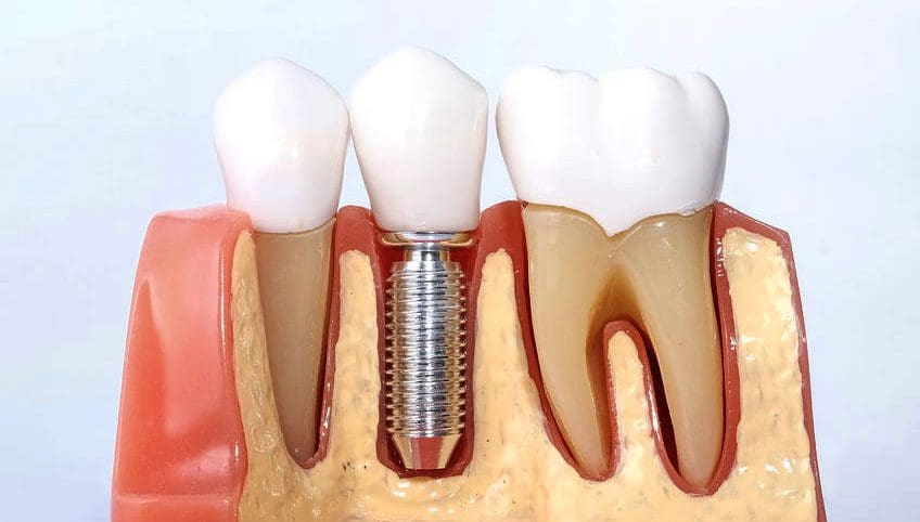 Guide to Dental Implants